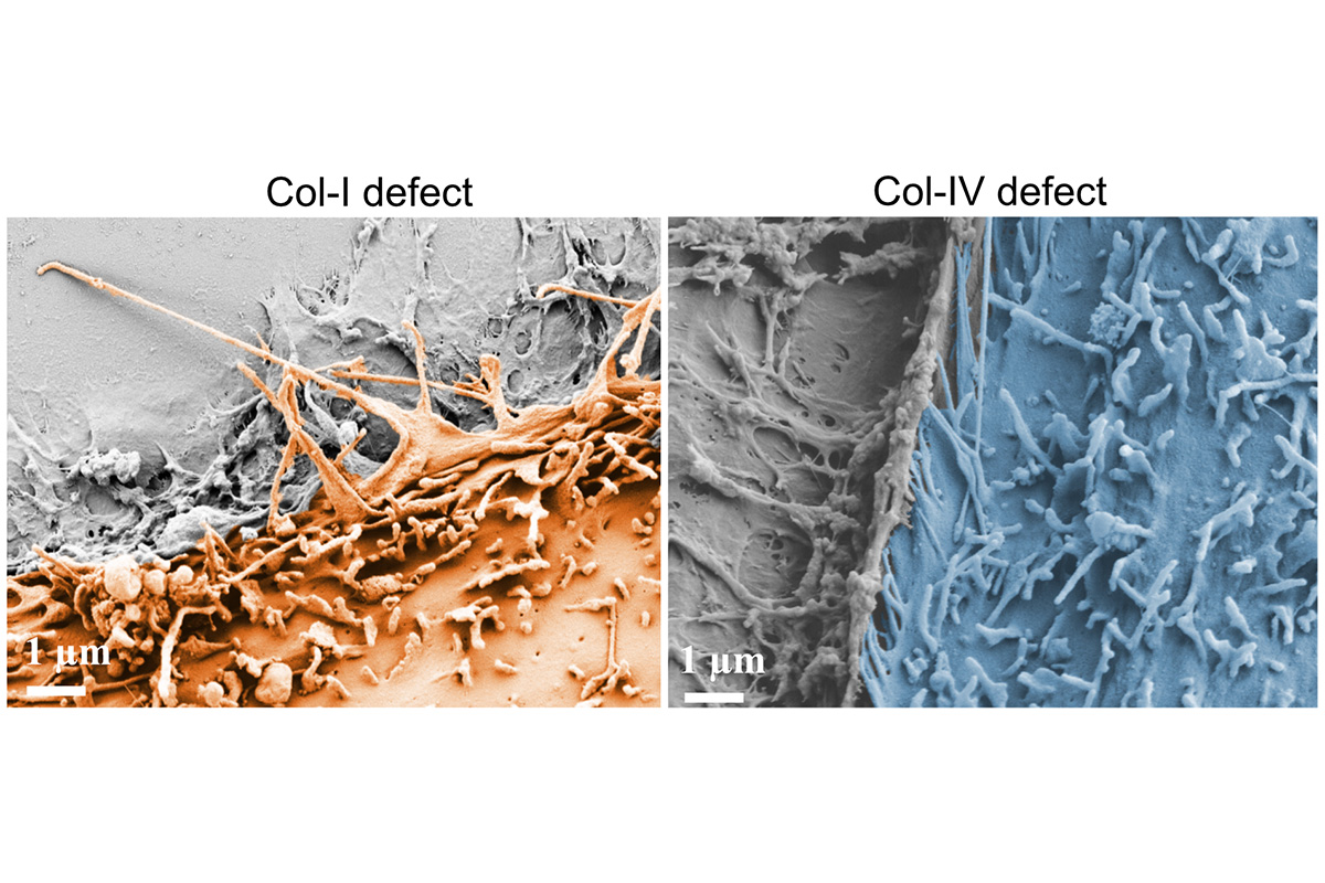 Scanning electron microscopy (SEM) image of human mammary epithelial MCF10A cells (orange) stalled near a laser-ablated micro-defect on a collagen type I extracellular matrix surface showing longer filopodia compared to those in case of collage type IV (cells shown in blue). Scale bar: 1µm. (Credit: Hannah Zmuda, Department of Biomedical Engineering, Washington University in St. Louis, with support from the Washington University Cellular Imaging Center (WUCCI))  